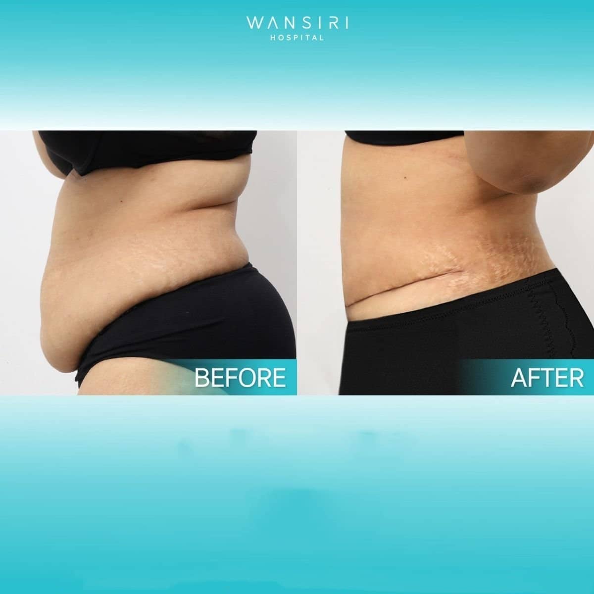 Case 17596 - liposuction