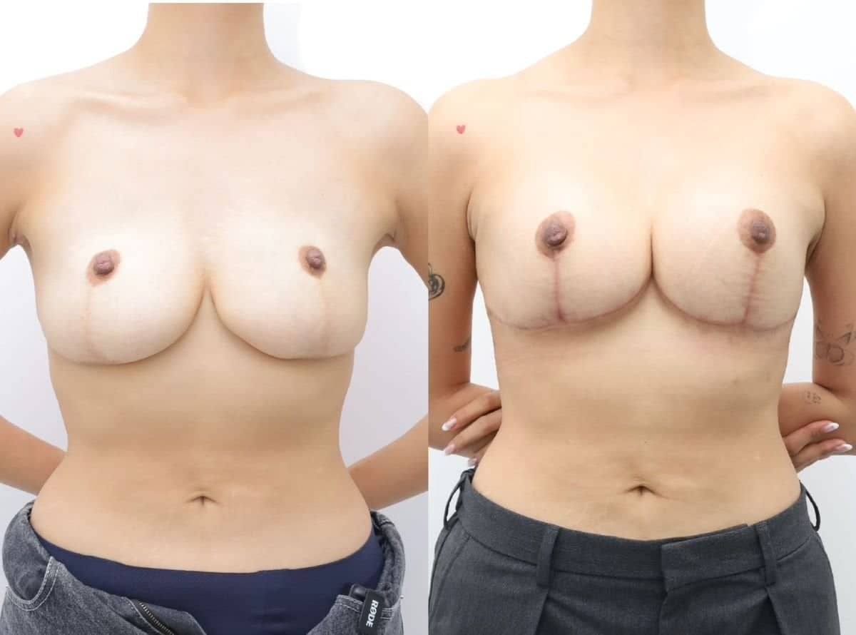 Case 17597 - breast lift
