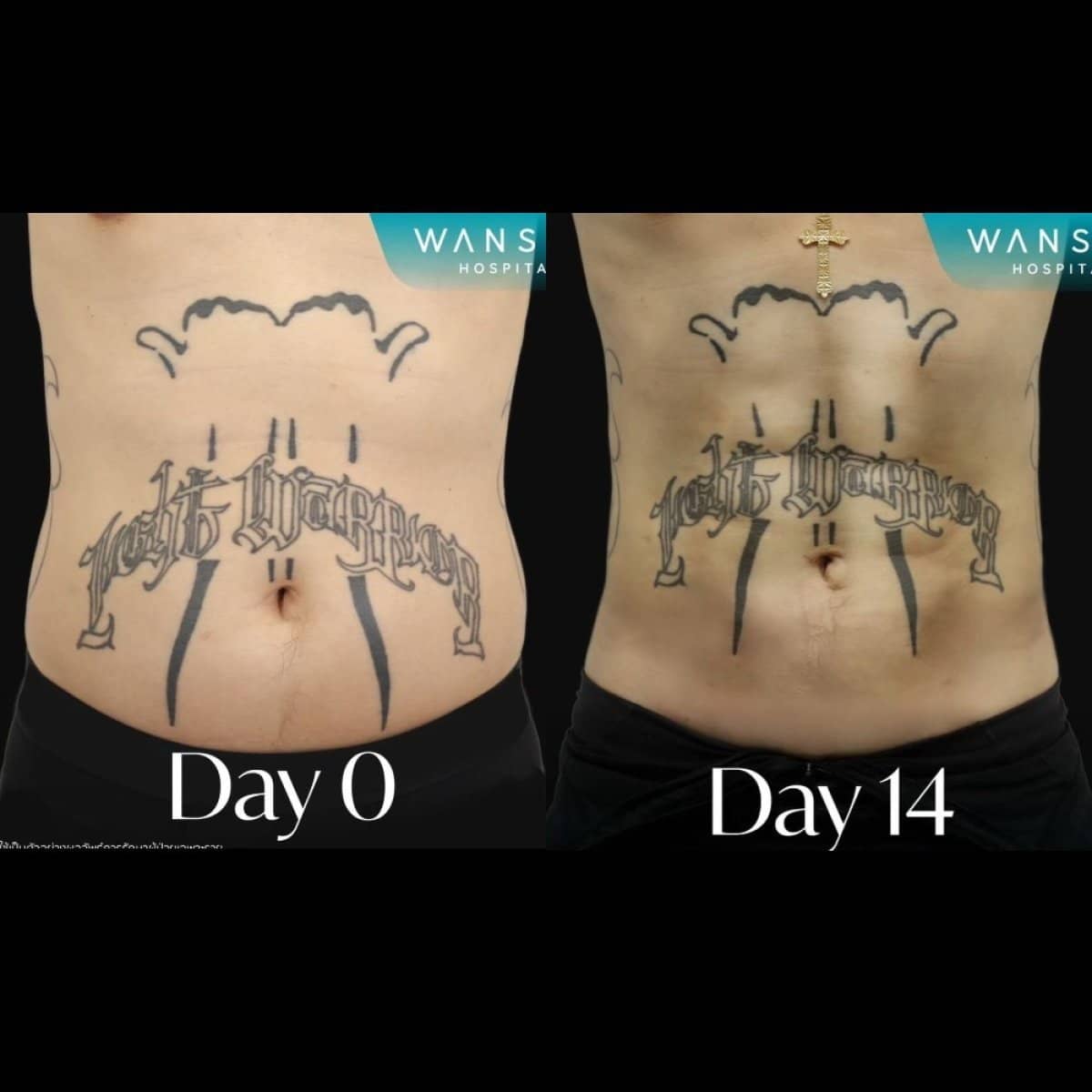 Case 17598 - Vaser liposuction