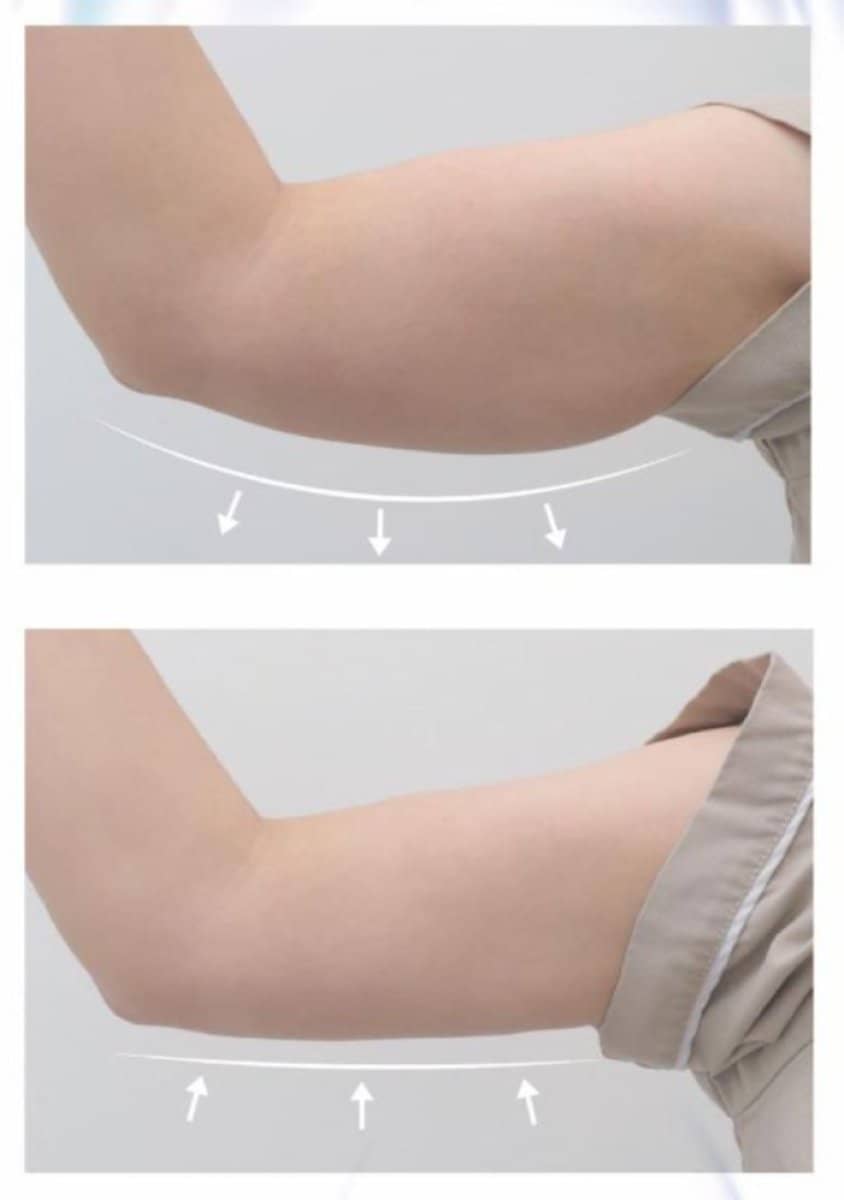 Case 17599 - arm liposuction