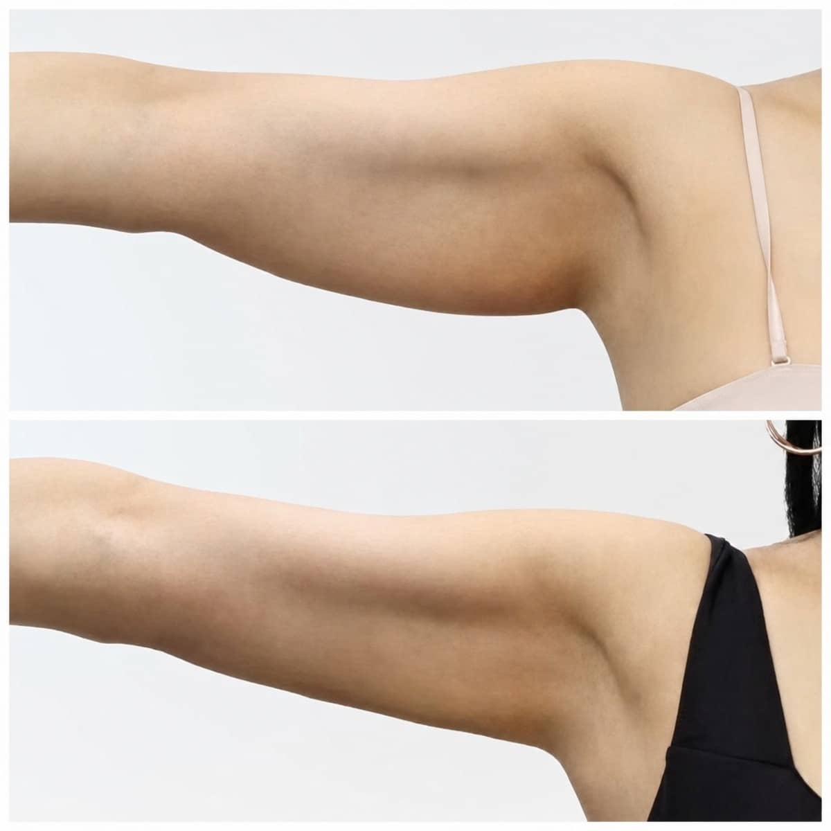Case 17600 - arm lift (brachioplasty)