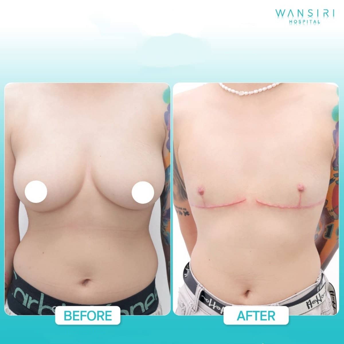 Case 17601 - top surgery