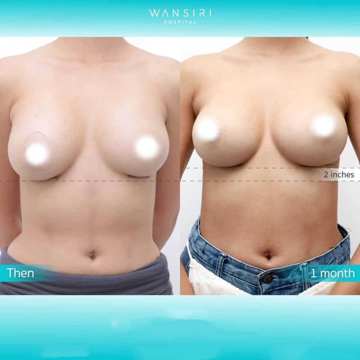 Case 17602 - breast lift