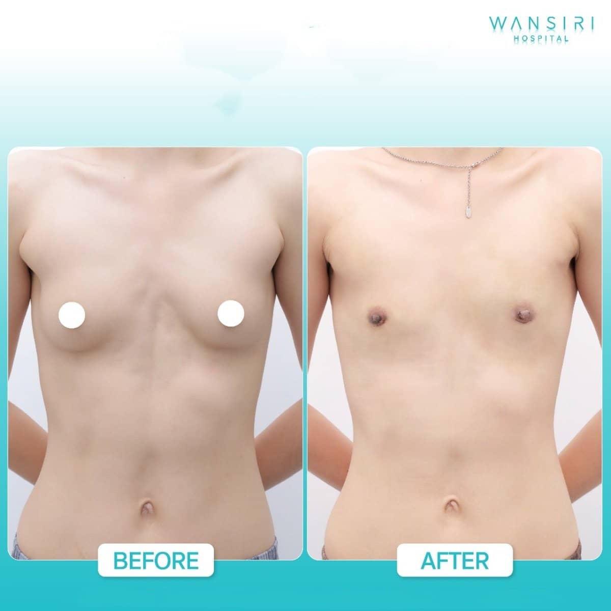 Case 17603 - top surgery