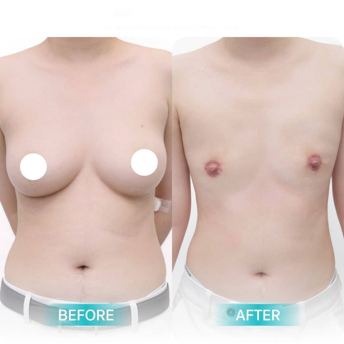 Case 17604 - top surgery