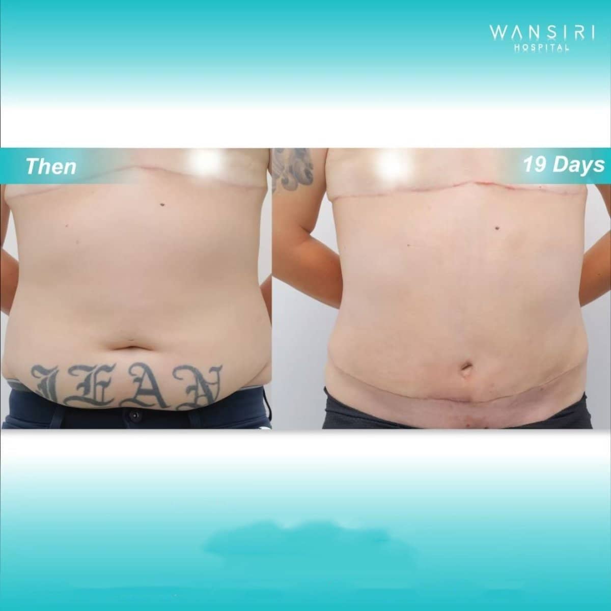 Case 17605 - liposuction