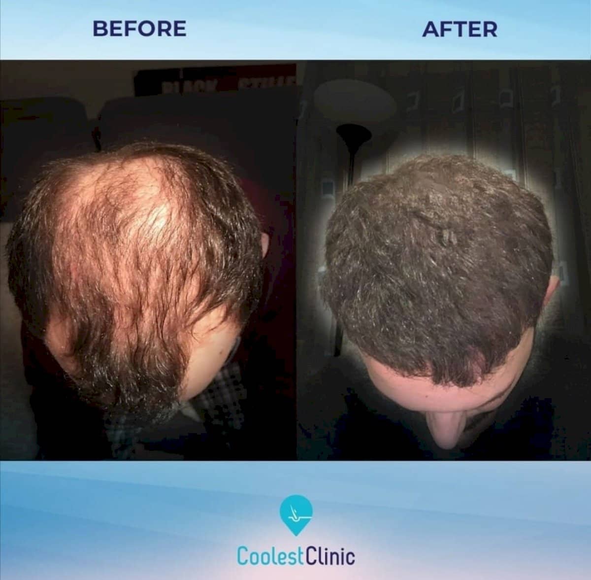 Case 17612 - FUE hair transplant