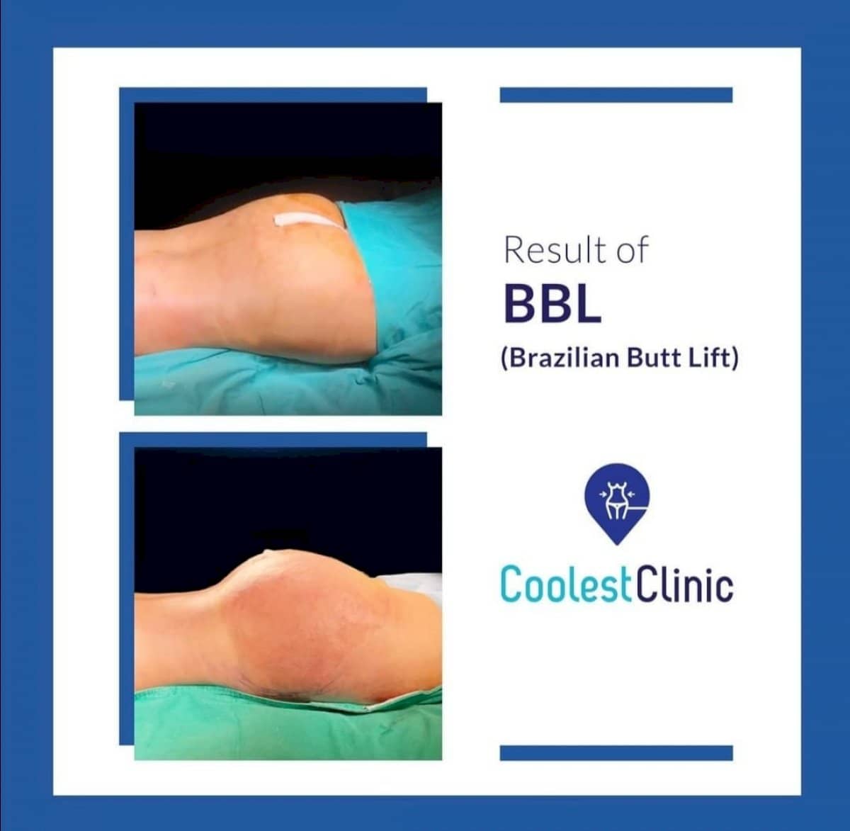 Case 17613 - Brazilian Butt Lift
