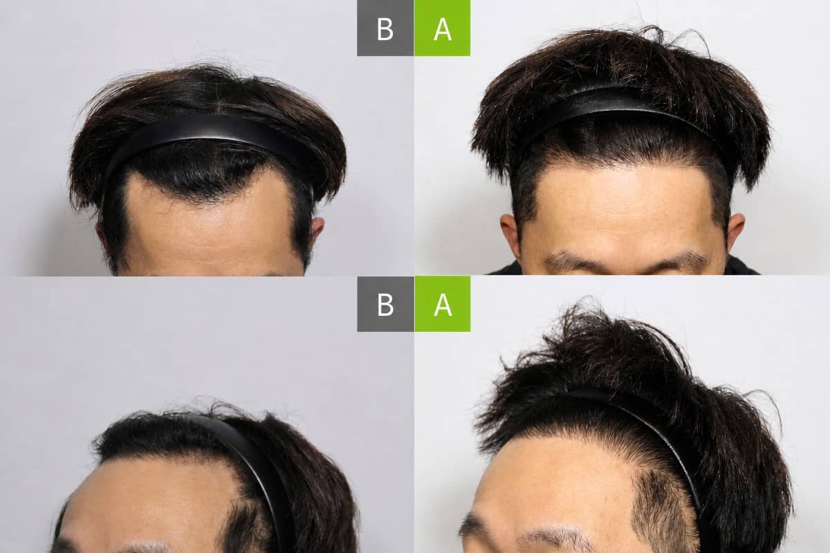 Case 17650 - FUE hair transplant