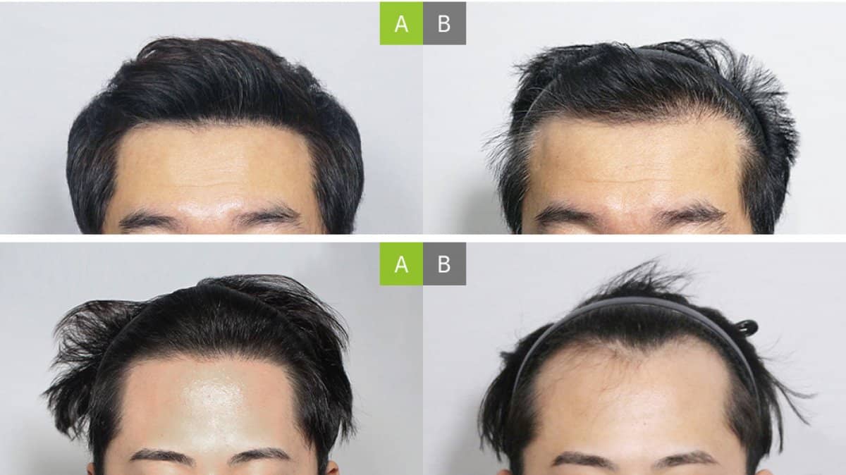 Case 17652 - hair transplant