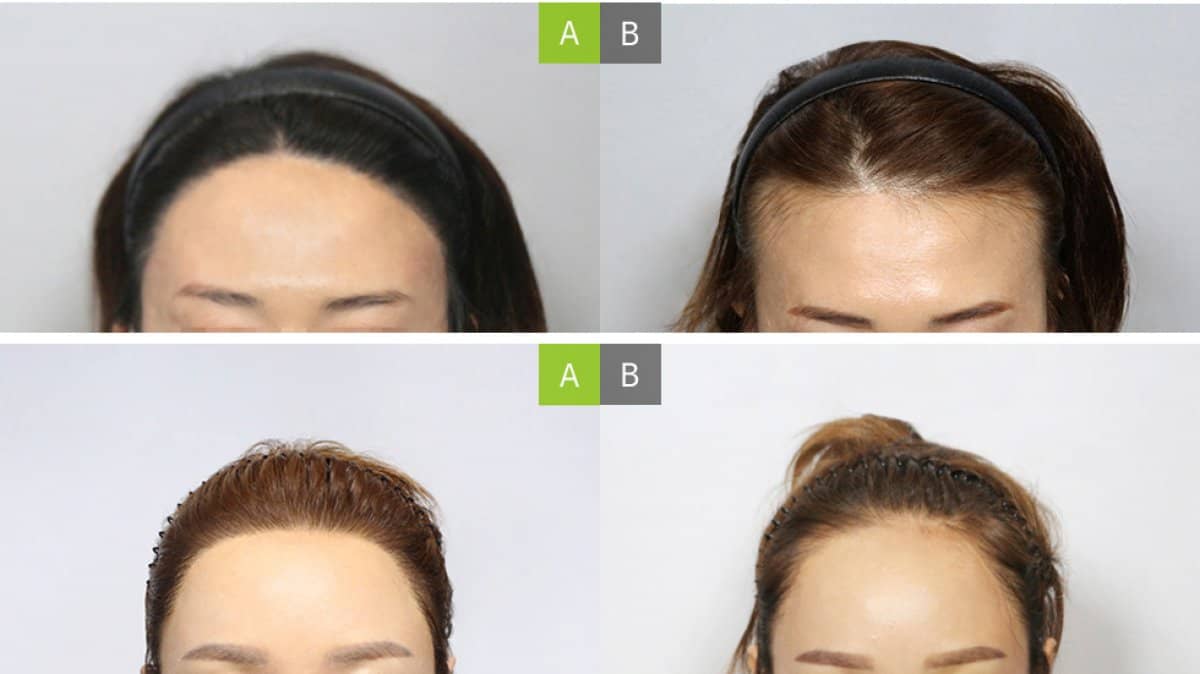 Case 17654 - hair transplant