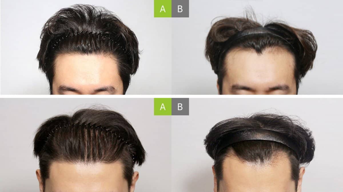 Case 17655 - hair transplant