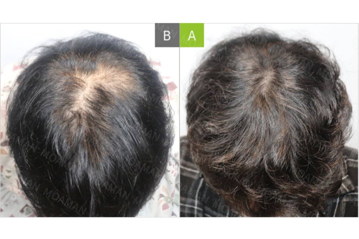Case 17693 - FUT hair transplant