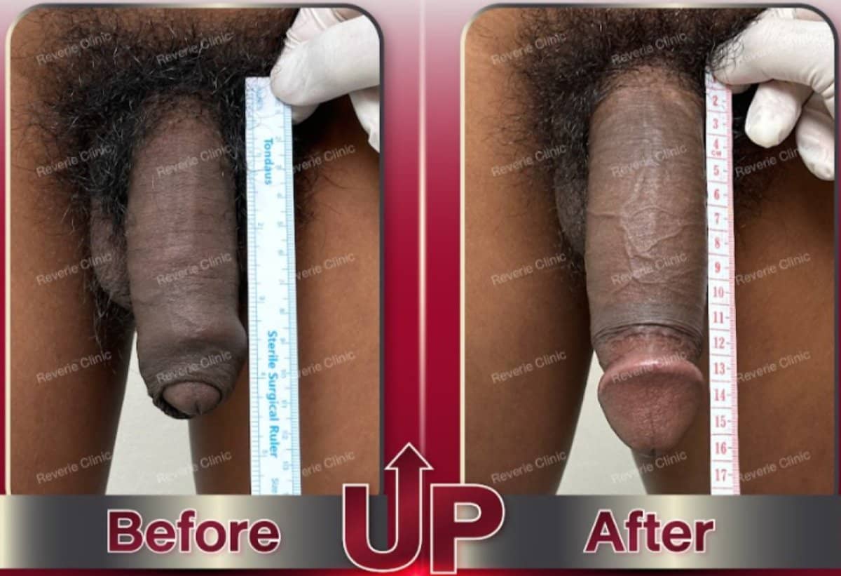 Case 17700 - penis filler
