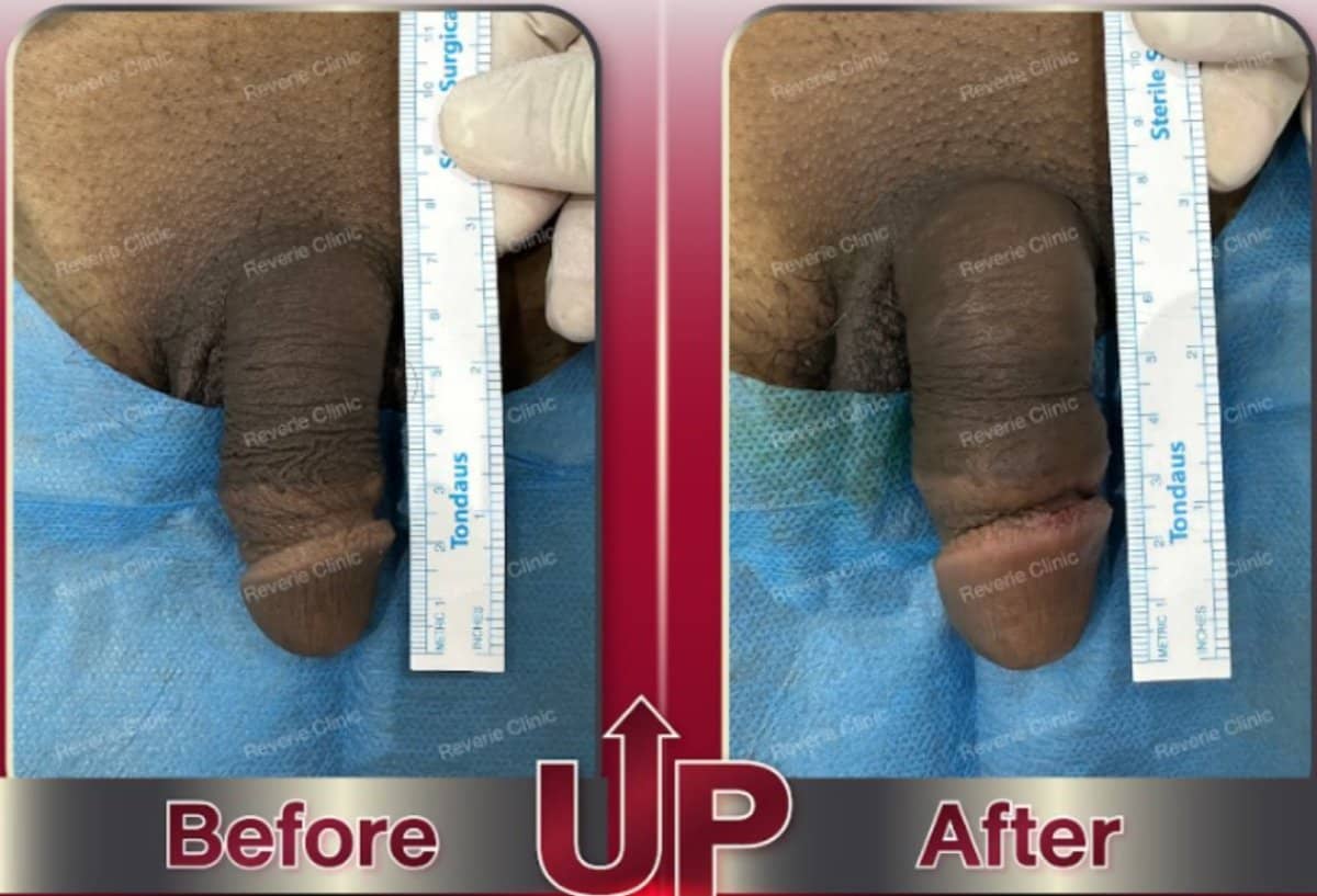 Case 17704 - penis filler
