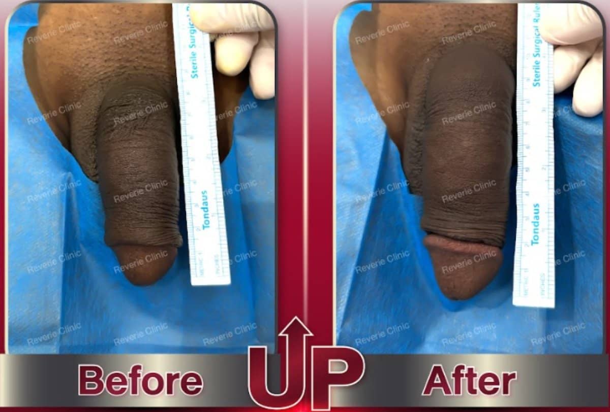 Case 17707 - penis filler