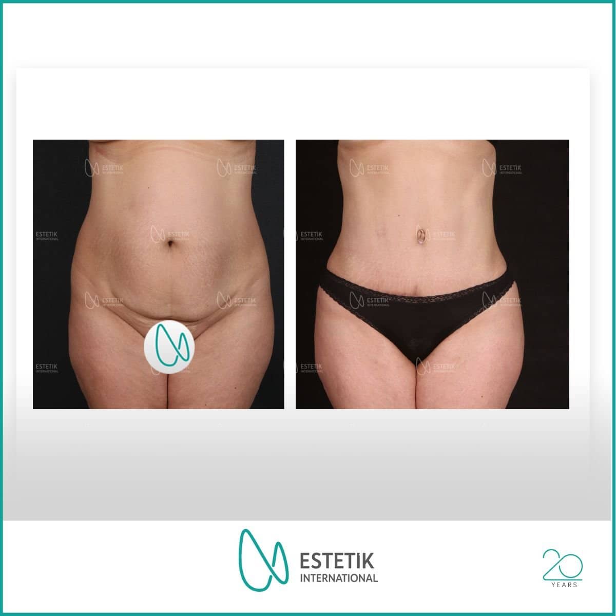 Case 17773 - tummy tuck