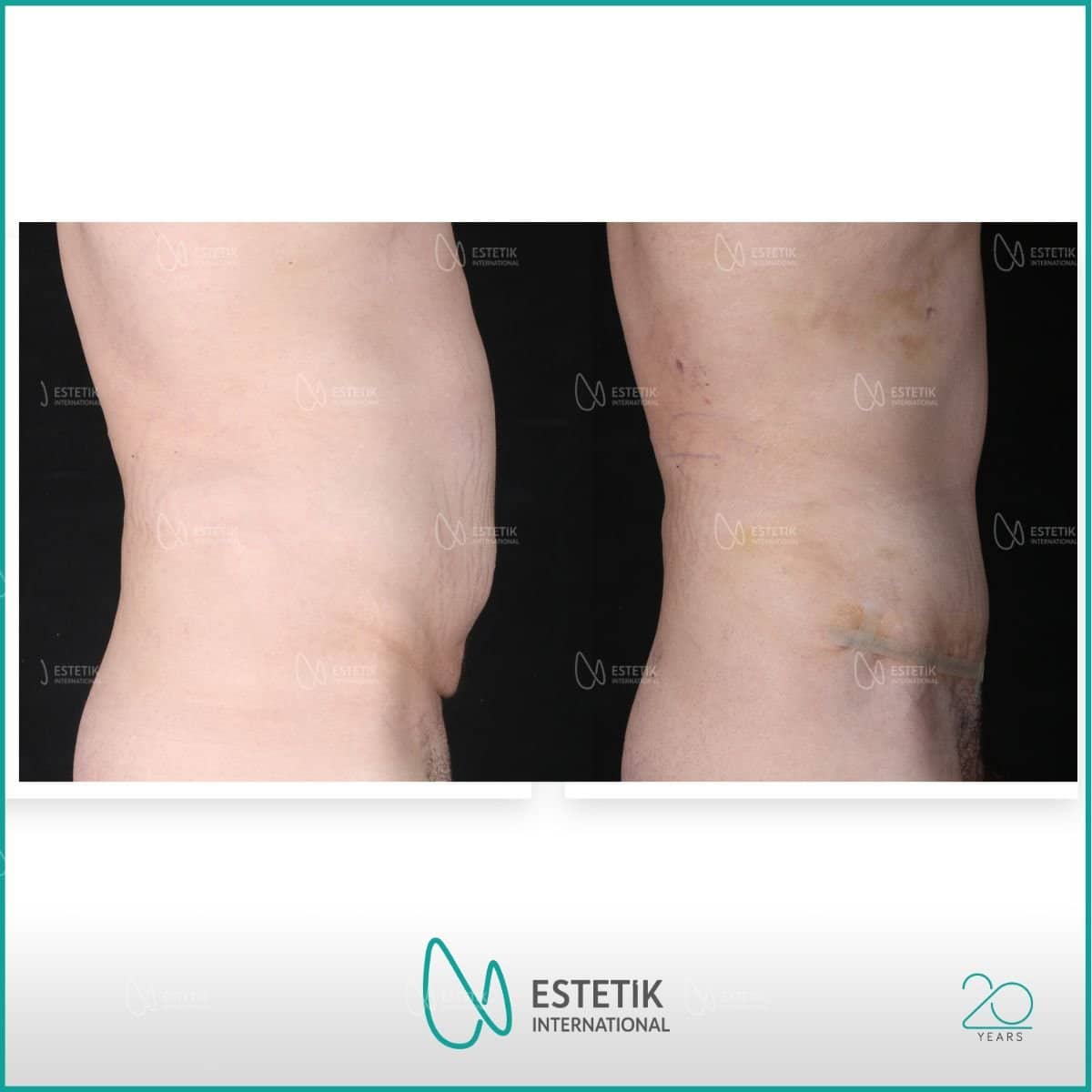Case 17776 - tummy tuck