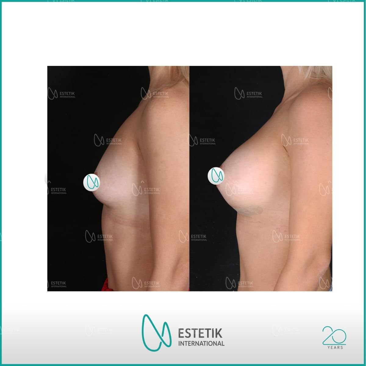 Case 17777 - lipofilling breast augmentation