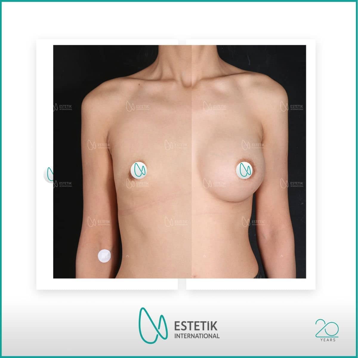 Case 17779 - lipofilling breast augmentation