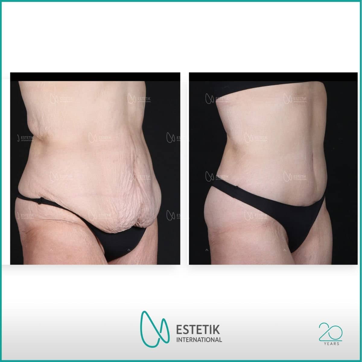 Case 17780 - tummy tuck