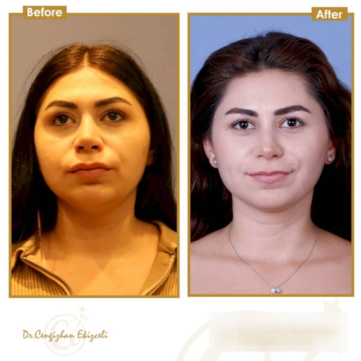 Case 17802 - buccal fat extraction