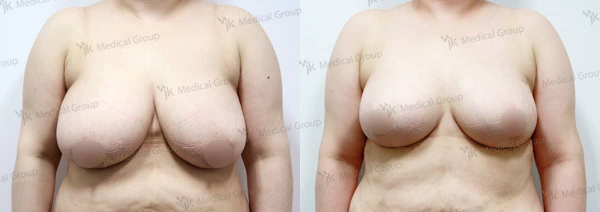 Case 17853 - breast reduction