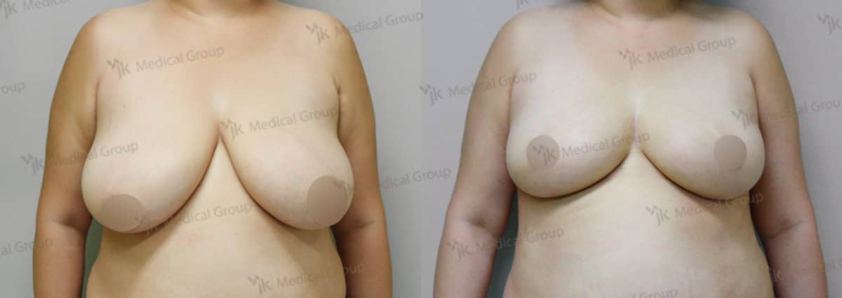 Case 17854 - breast reduction