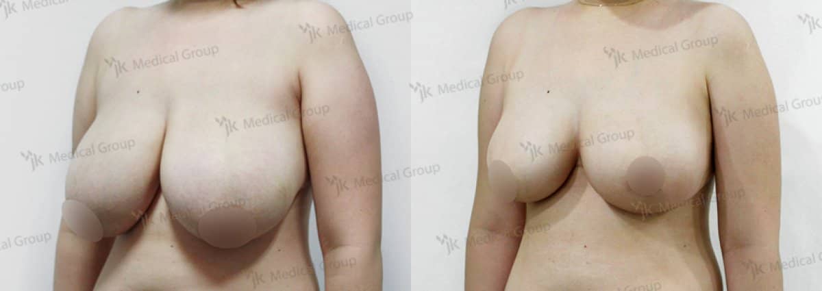Case 17855 - breast reduction