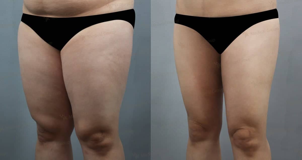 Case 17856 - liposuction