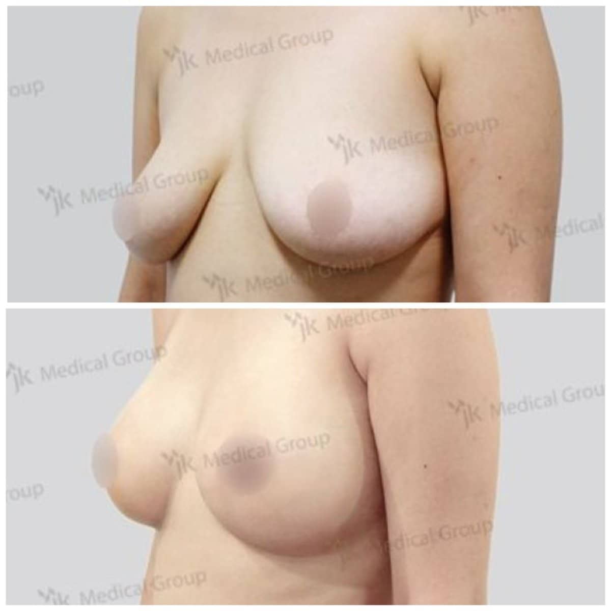 Case 17857 - mommy makeover