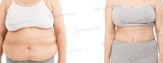 Case 17858 - tummy tuck