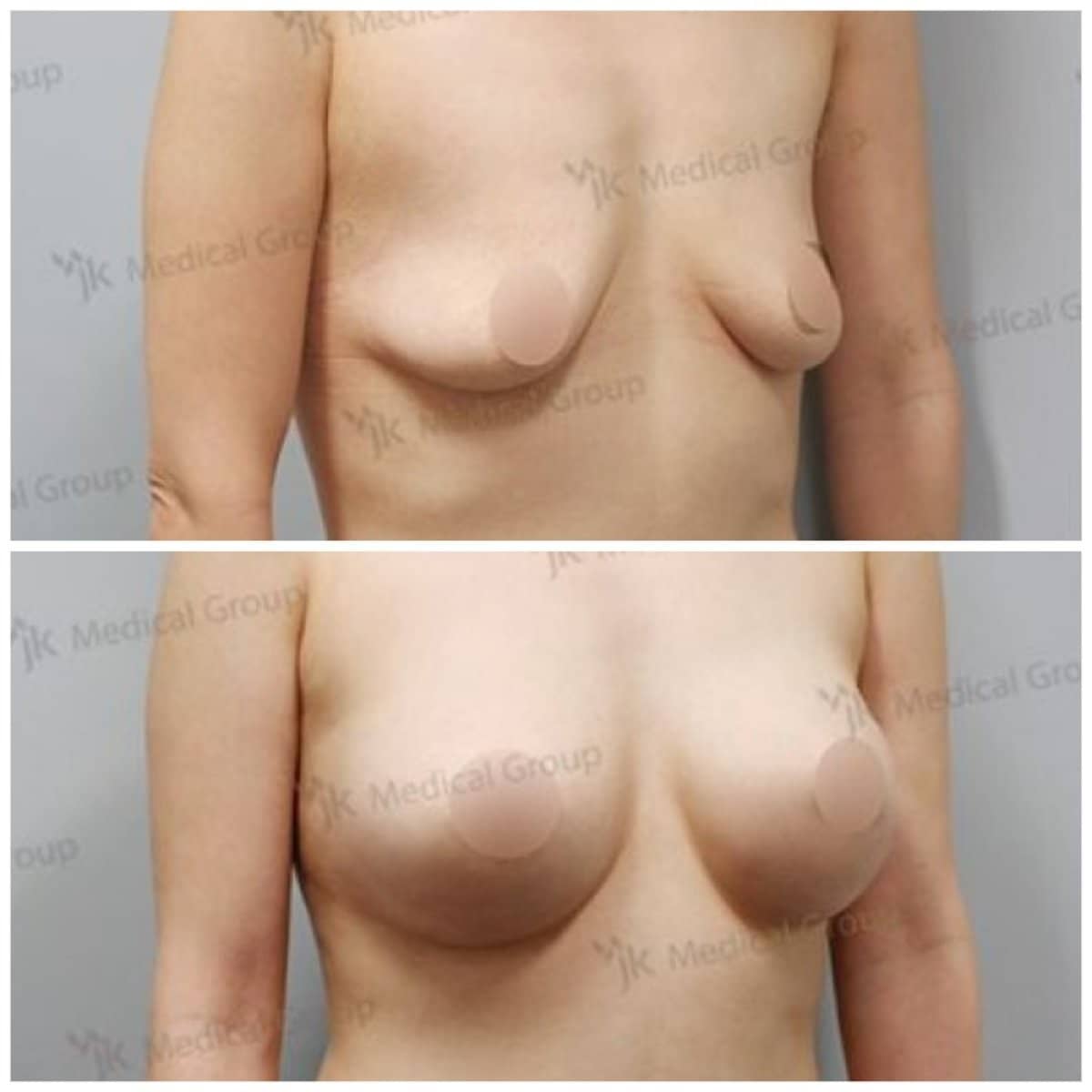 Case 17859 - mommy makeover