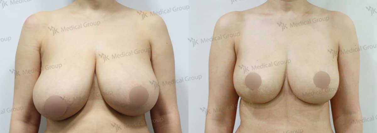 Case 17860 - breast reduction