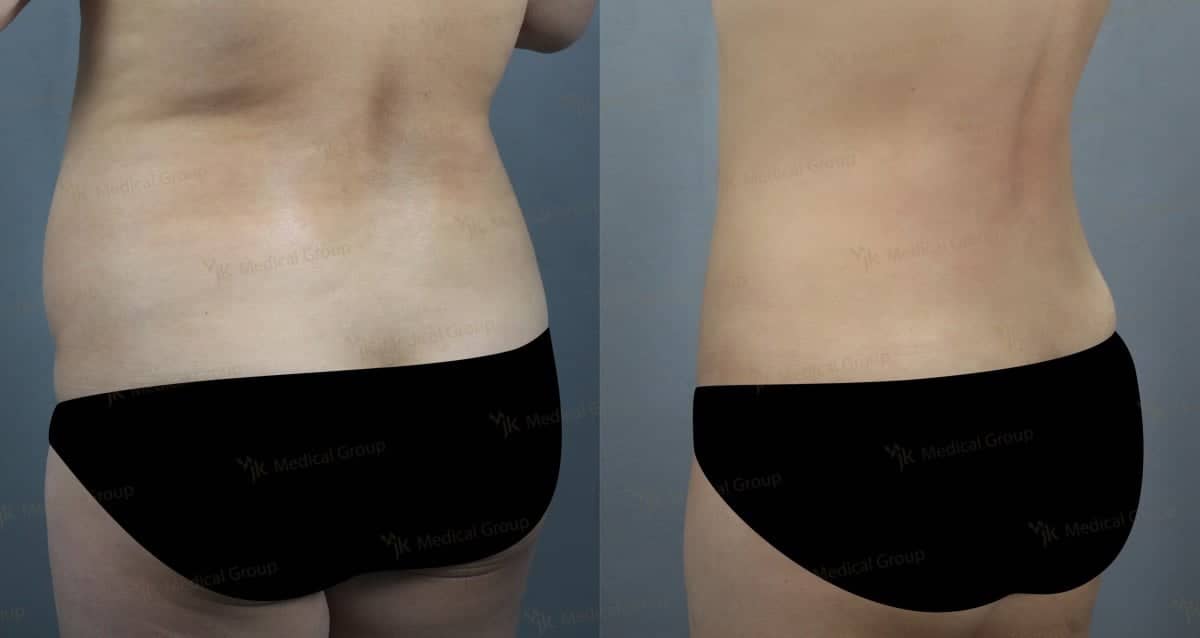 Case 17861 - liposuction