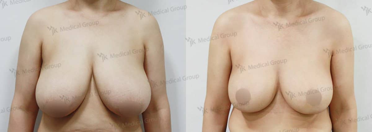 Case 17862 - breast reduction