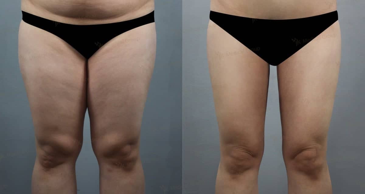 Case 17863 - liposuction
