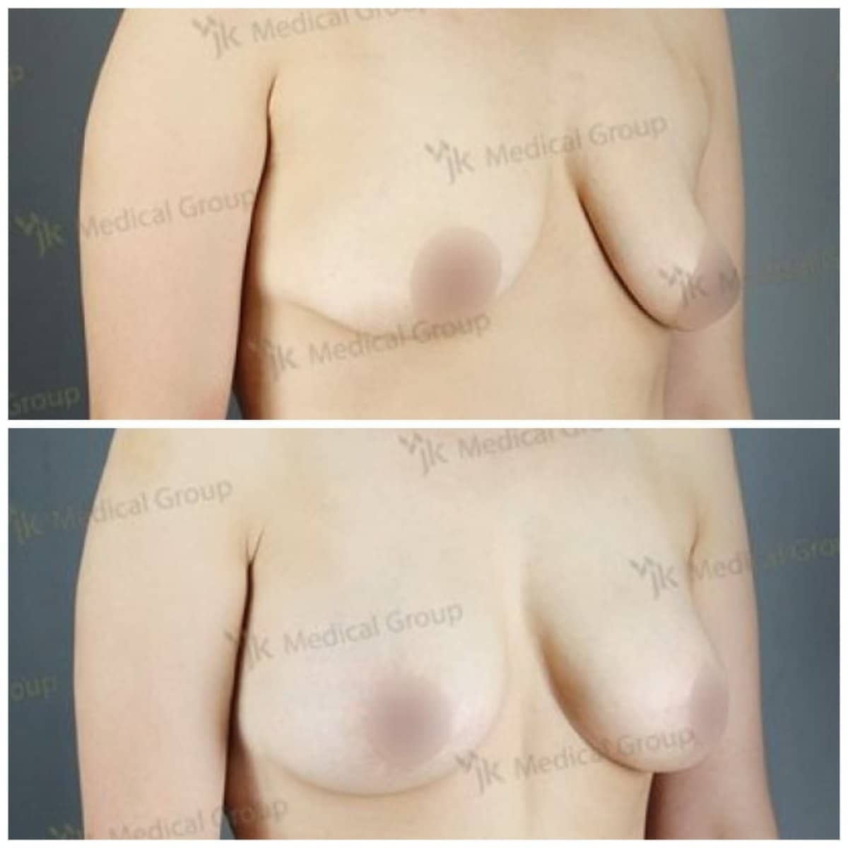 Case 17866 - mommy makeover