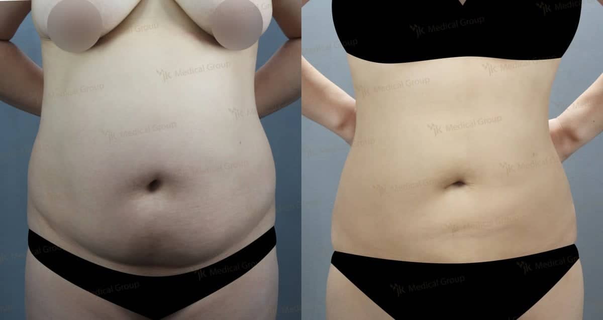 Case 17867 - liposuction