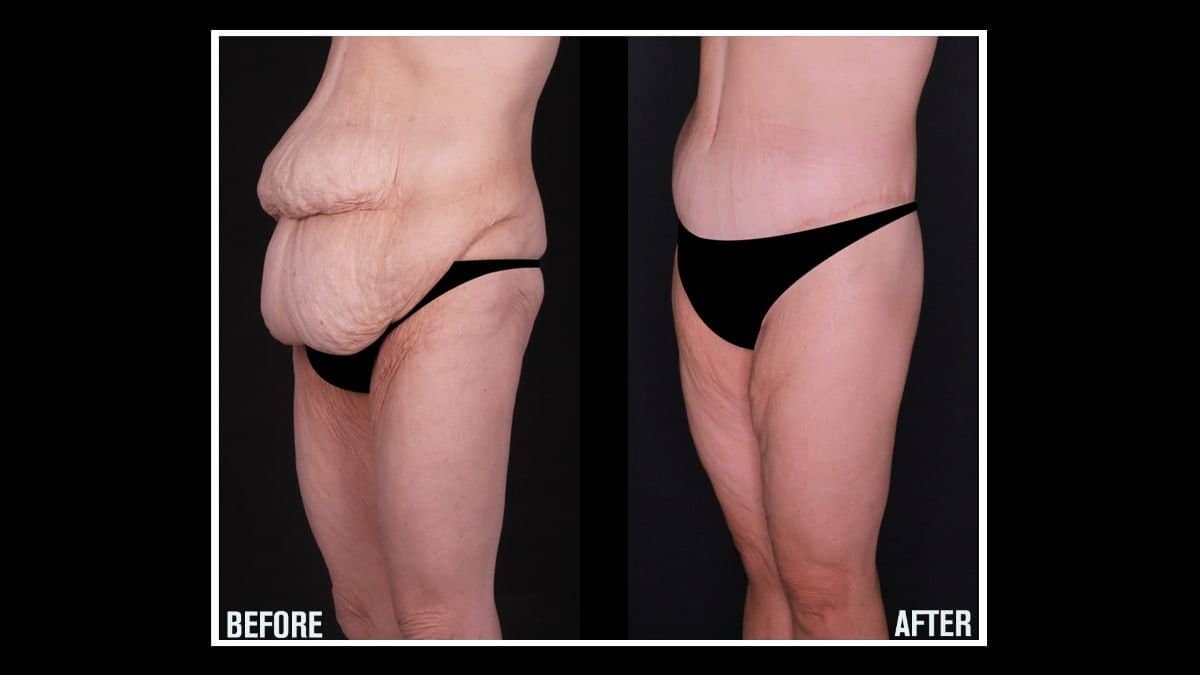 Case 17916 - tummy tuck and liposuction