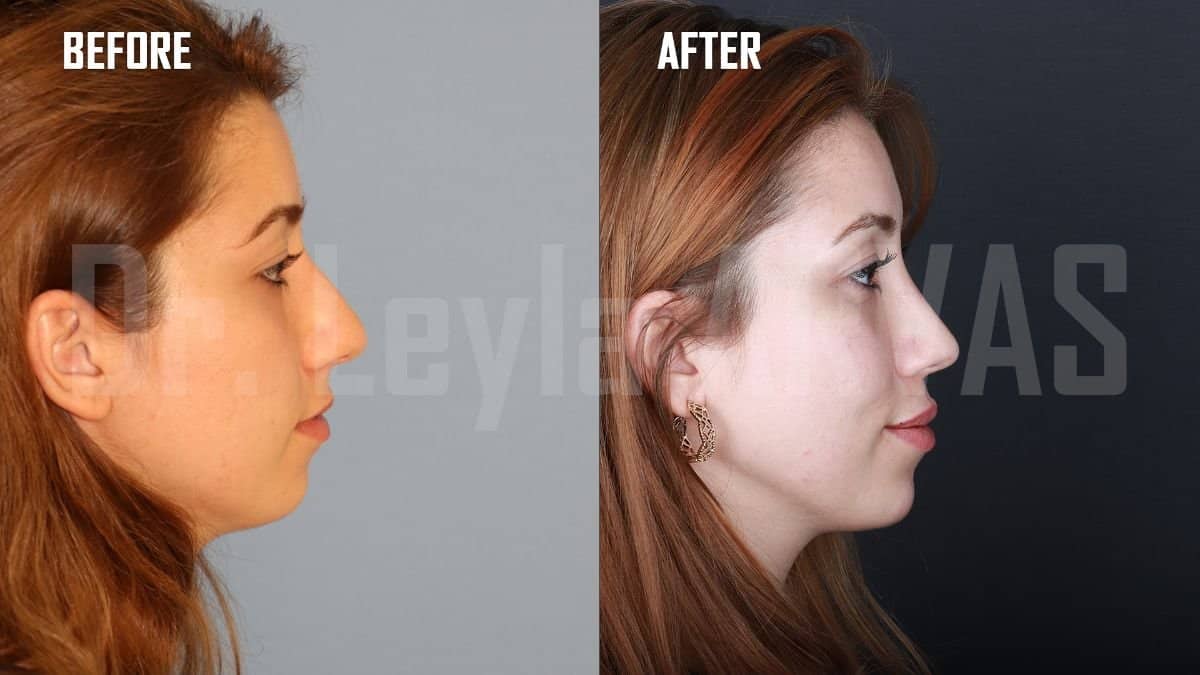 Case 17917 - rhinoplasty