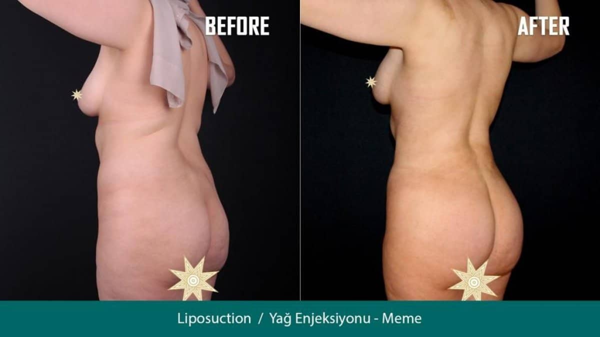 Case 17918 - Brazilian Butt Lift