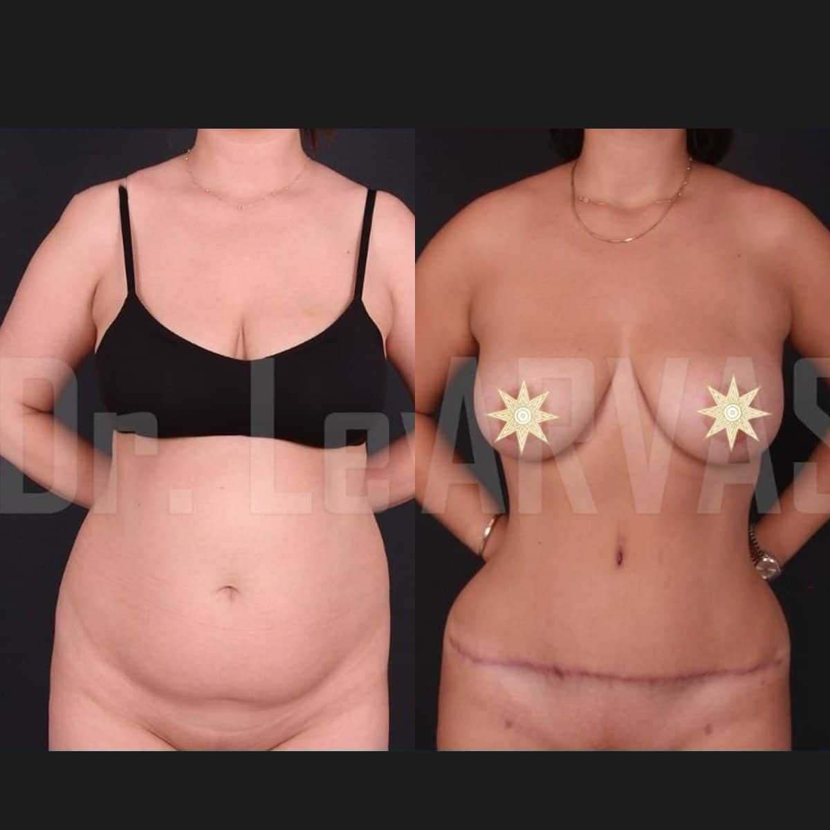 Case 17919 - tummy tuck and liposuction