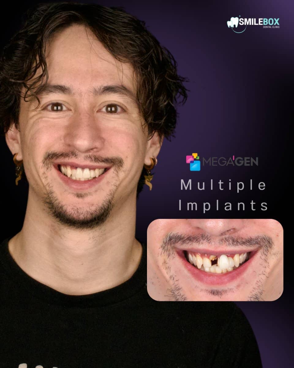 Case 17920 - dental implants