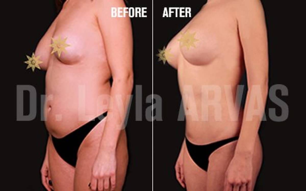 Case 17922 - Vaser liposuction