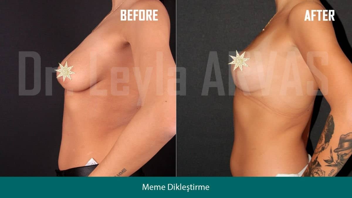 Case 17923 - breast lift