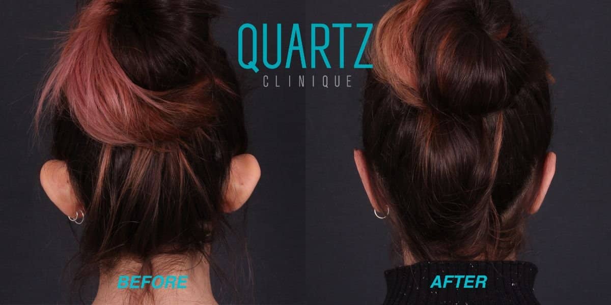 Case 17925 - otoplasty