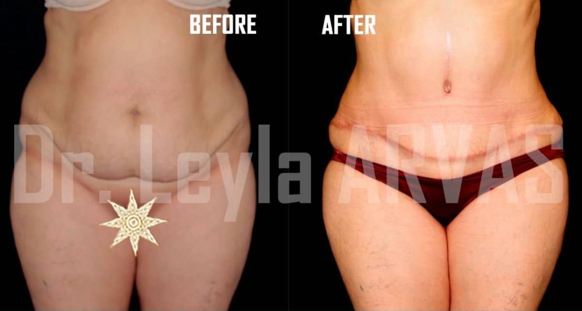 Case 17927 - Vaser liposuction