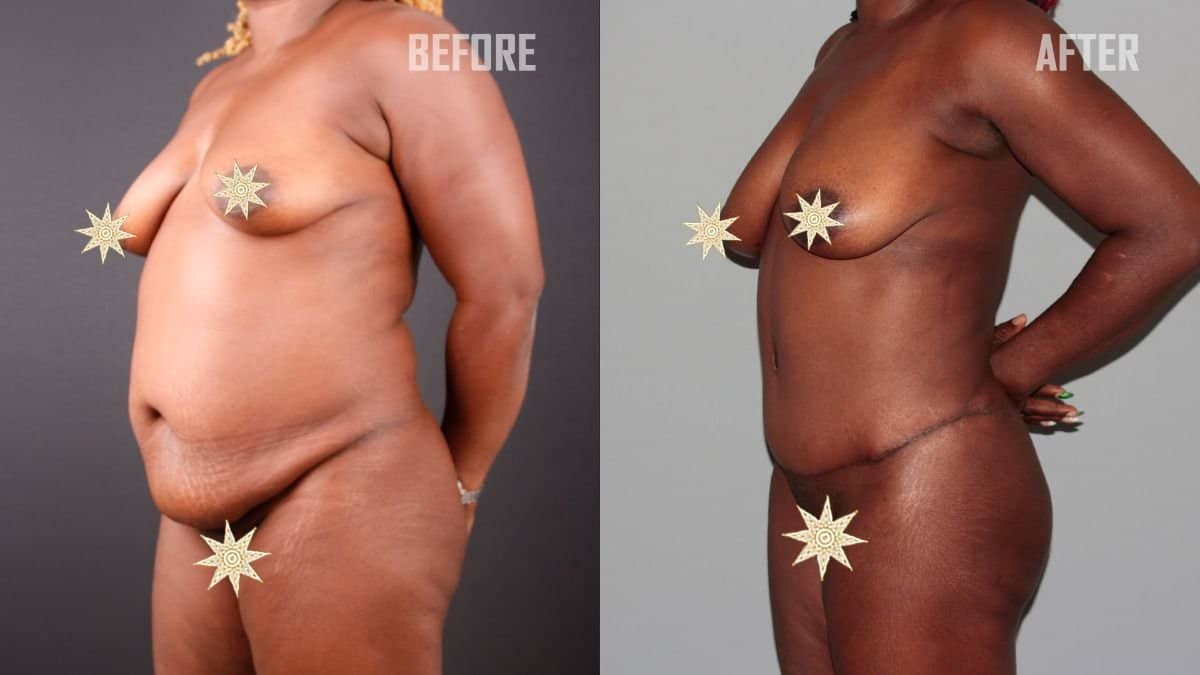 Case 17928 - Vaser liposuction