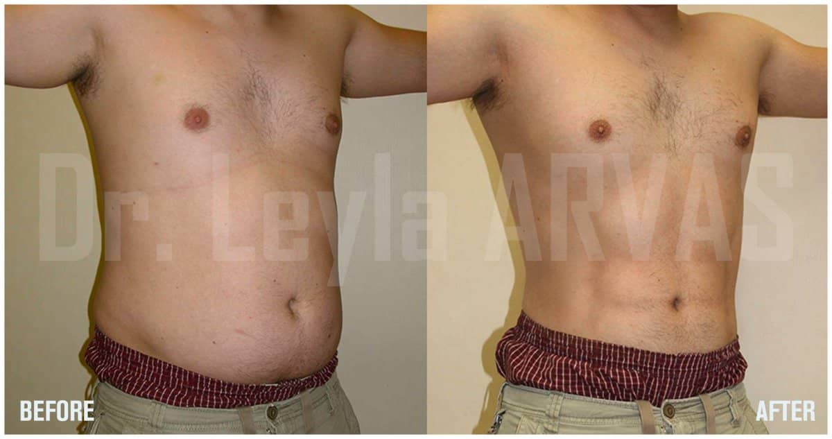 Case 17932 - abdominal etching